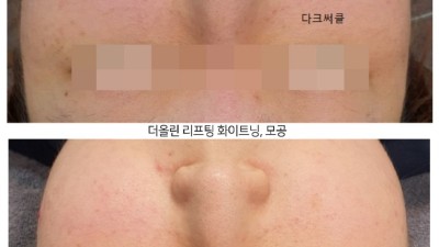 리프팅 전후